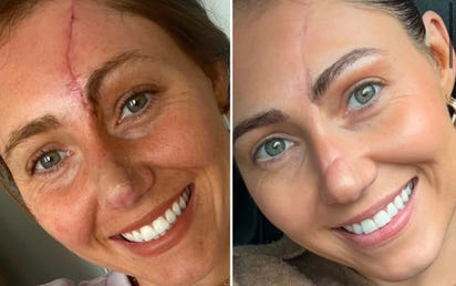 Portable Red Light Therapy Torch