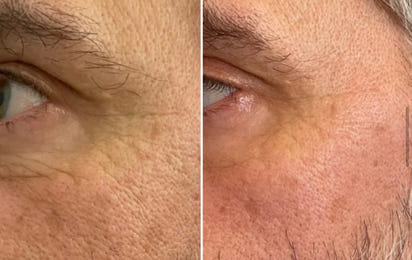 Portable Red Light Therapy Torch